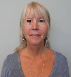 Face Lift Case 9 After