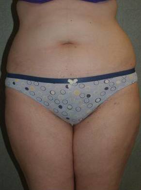 Liposuction Case 2 Before