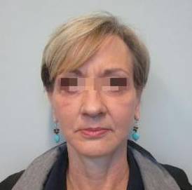 Face Lift Case 8 After