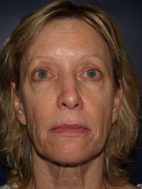 Face Lift Case 3 Before