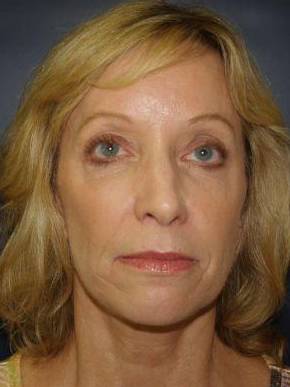 Face Lift Case 3 After