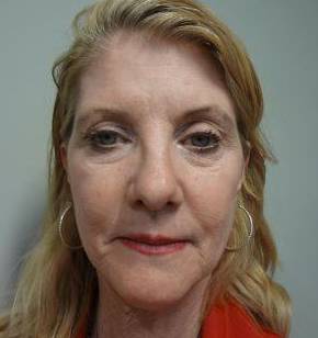 Face Lift Case 5 Before