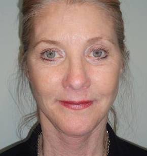 Face Lift Case 5 After