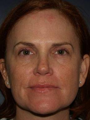 Face Lift Case 1 Before