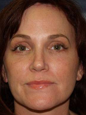 Face Lift Case 1 After
