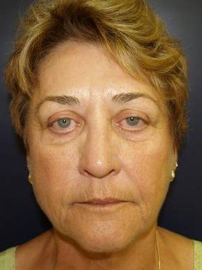 Face Lift Case 2 Before