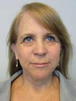 Face Lift Case 7 After