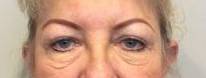 Blepharoplasty Case 9 Before