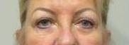 Blepharoplasty Case 9 After