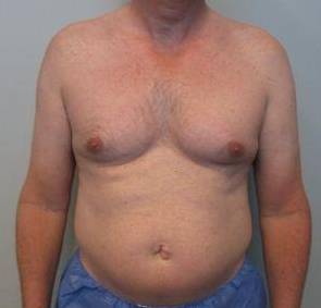 Liposuction Case 3 Before