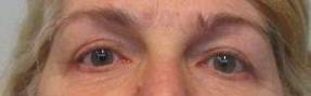 Blepharoplasty Case 12 After