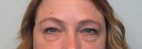 Blepharoplasty Case 11 Before