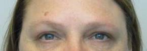 Blepharoplasty Case 11 After