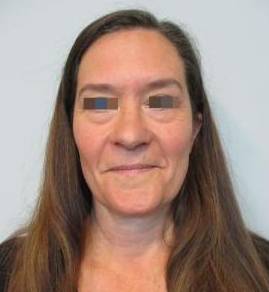 Blepharoplasty Case 10 Before