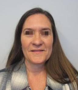 Blepharoplasty Case 10 After