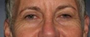 Blepharoplasty Case 2 Before