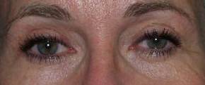 Blepharoplasty Case 2 After