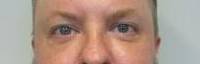 Blepharoplasty Case 8 After
