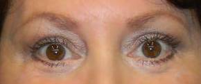 Blepharoplasty Case 6 After