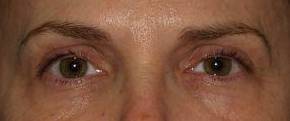 Blepharoplasty Case 1 Before