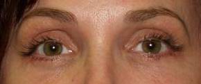 Blepharoplasty Case 1 After