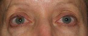 Blepharoplasty Case 5 Before