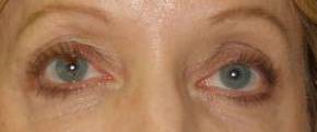 Blepharoplasty Case 5 After