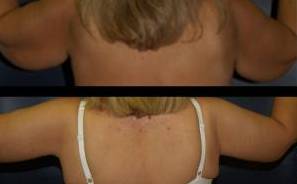 Arm Lift Case 2 After