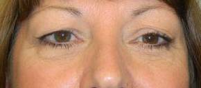 Blepharoplasty Case 7 Before