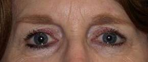 Blepharoplasty Case 4 Before