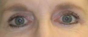 Blepharoplasty Case 4 After