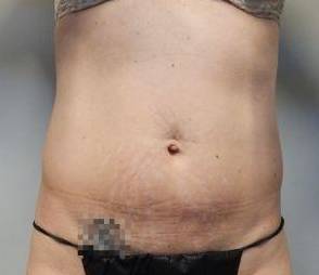 Abdominoplasty Case 23 Before