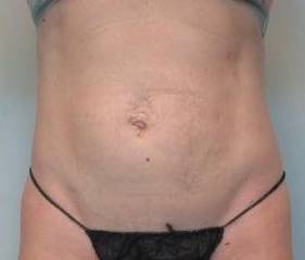 Abdominoplasty Case 24 Before