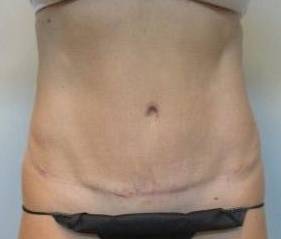 Abdominoplasty Case 24 After