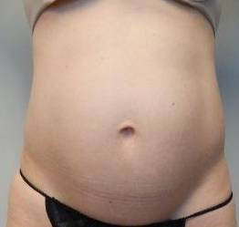 Abdominoplasty Case 25 Before