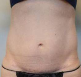 Abdominoplasty Case 25 After