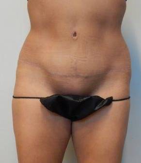 Abdominoplasty Case 26 After