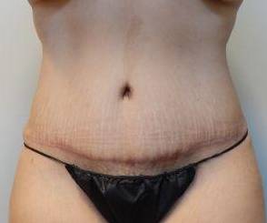 Abdominoplasty Case 27 After