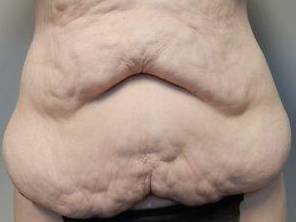 Abdominoplasty Case 28 Before