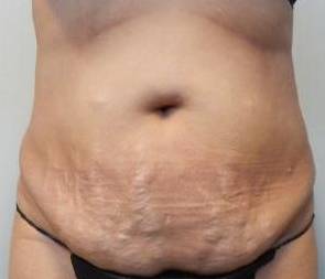 Abdominoplasty Case 29 Before