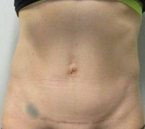 Abdominoplasty Case 30 After