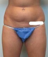 Liposuction Case 4 Before