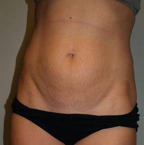 Abdominoplasty Case 1 Before