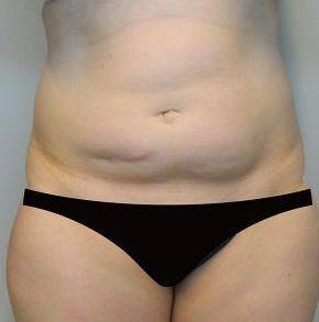 Abdominoplasty Case 2 Before