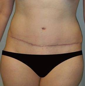 Abdominoplasty Case 2 After