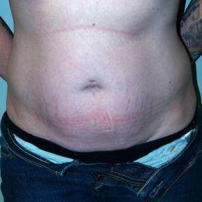 Abdominoplasty Case 3 Before
