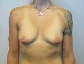 Breast Augmentation Case 29 Before