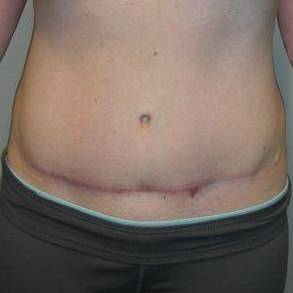 Abdominoplasty Case 3 After