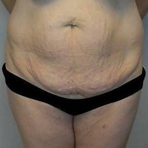 Abdominoplasty Case 4 Before