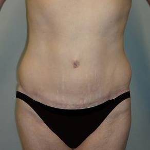 Abdominoplasty Case 4 After
